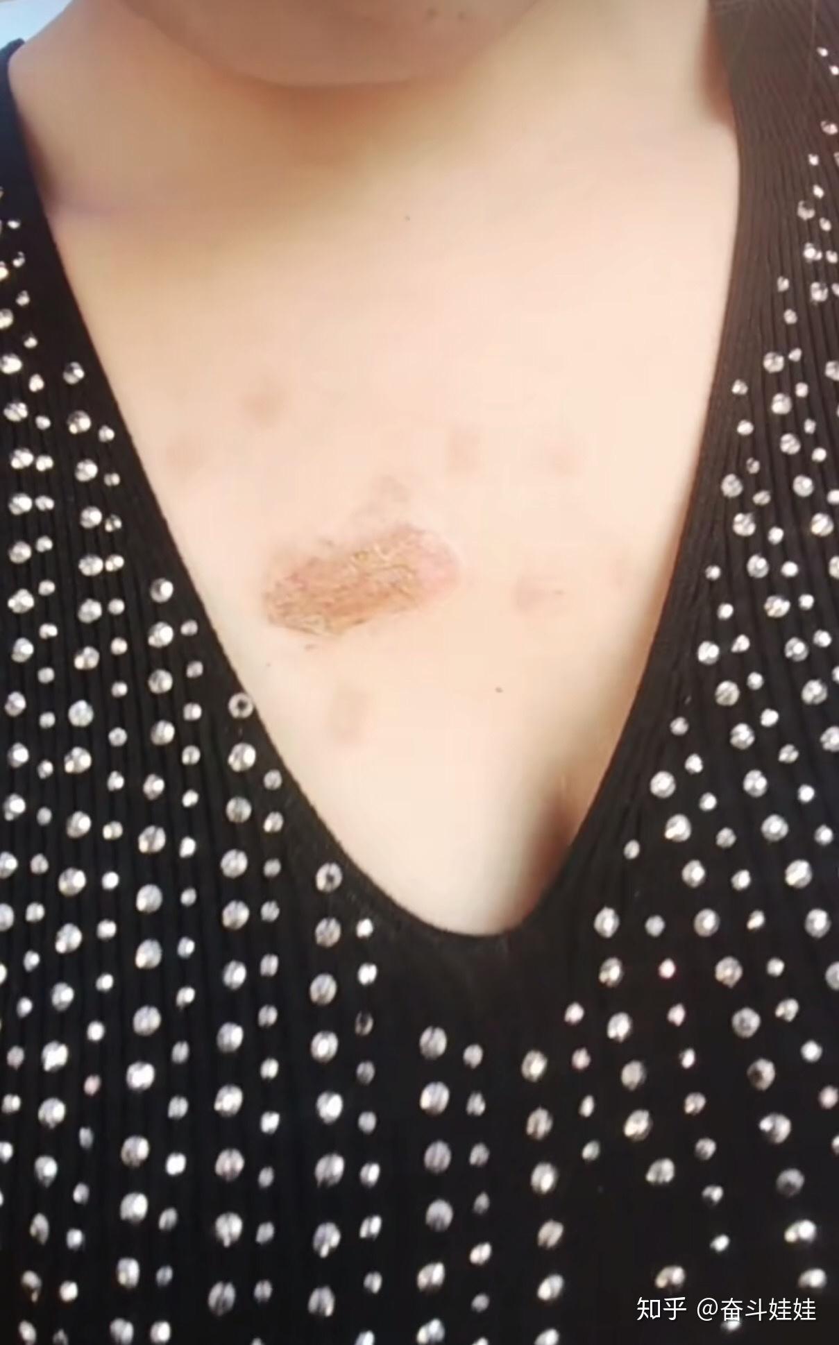 十多年的疤痕疙瘩一层层脱皮变化中