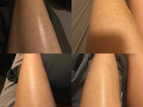 鸡皮肤吧友(你有鸡皮肤吗)