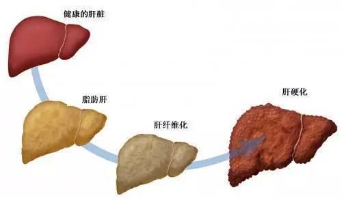 改善脂肪肝做到這八點就可以