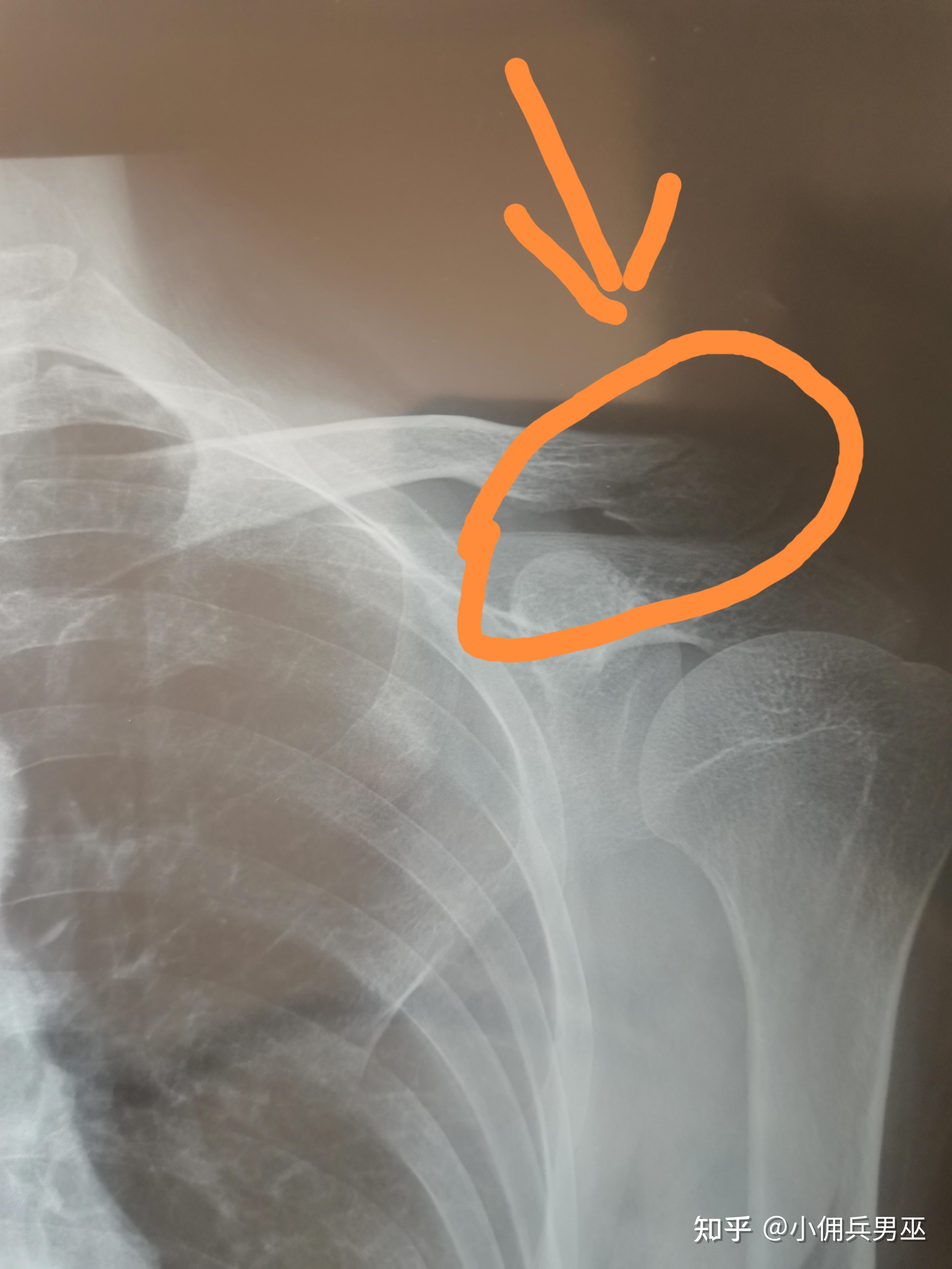 左侧锁骨远端骨折保守治疗记录