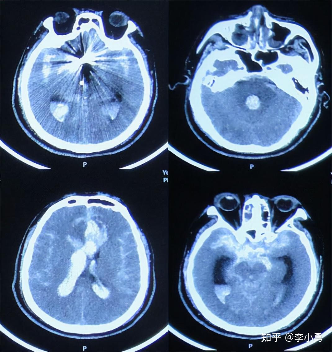 男子的脑袋里同时长了两个恶性肿瘤！如何选择治疗让人犯难 - 哔哩哔哩