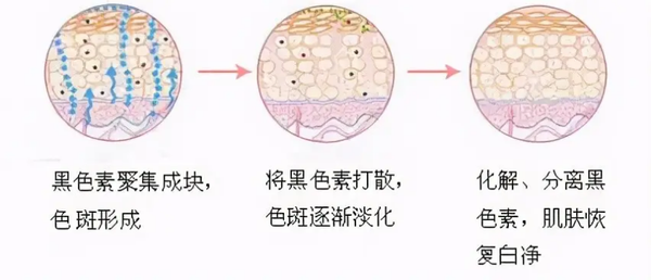 脸部激光祛斑要多少钱 医美祛斑真的有用吗？激光、皮秒、超皮秒哪个最有效？大概多少钱？