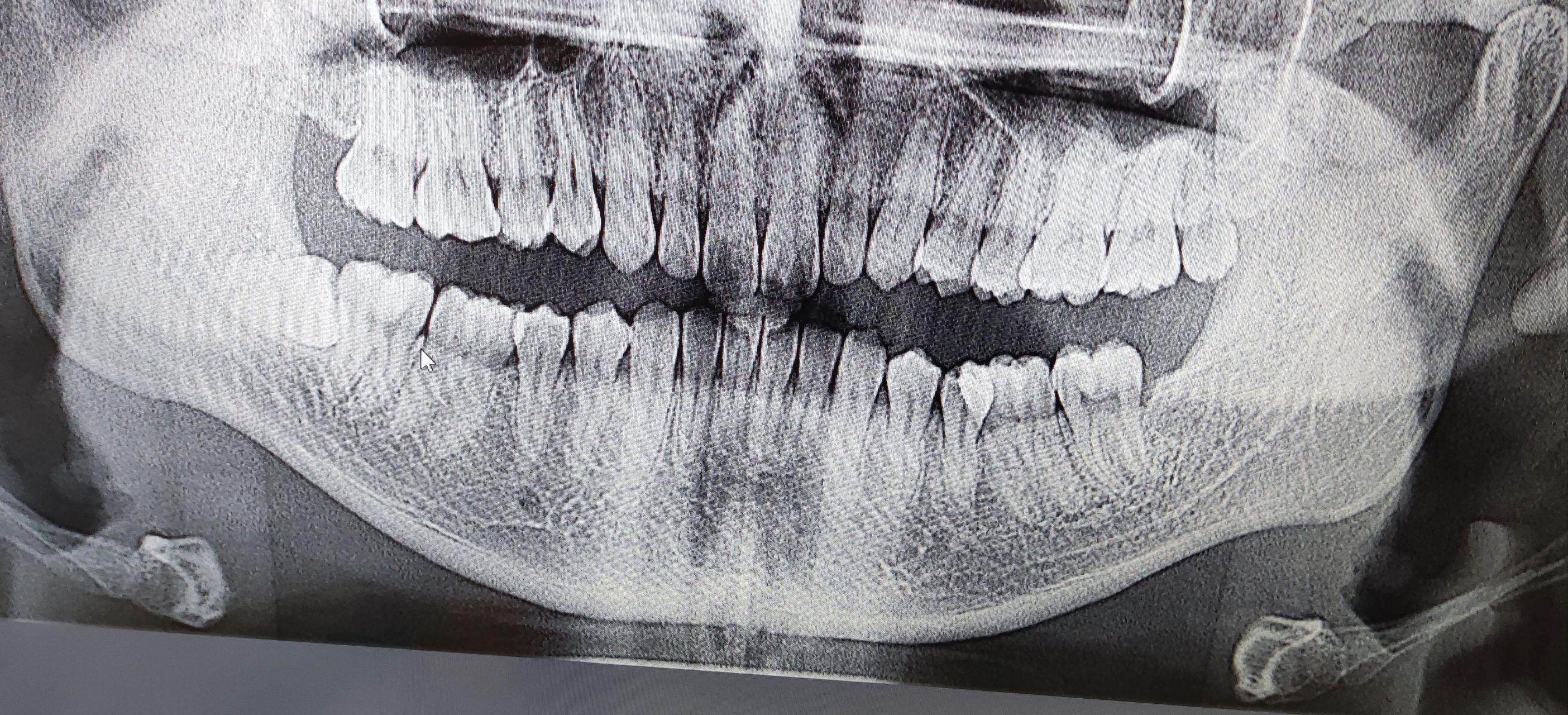 口腔口变色牙与牙裂牙及牙髓坏死 编辑类照片. 图片 包括有 堵嘴, 患者, 疾病, 医学, 褪色, 牙科 - 180502086
