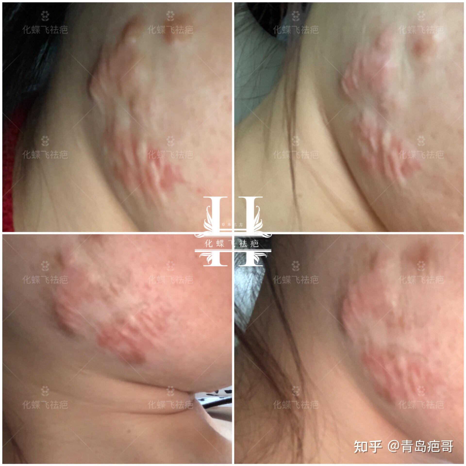 顽固性痤疮结节疤痕