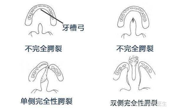 腭裂术后瘘孔图片图片