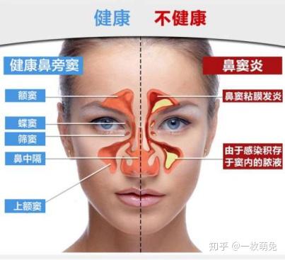 超简单10种鼻炎类型自我诊断法 史上最全 知乎