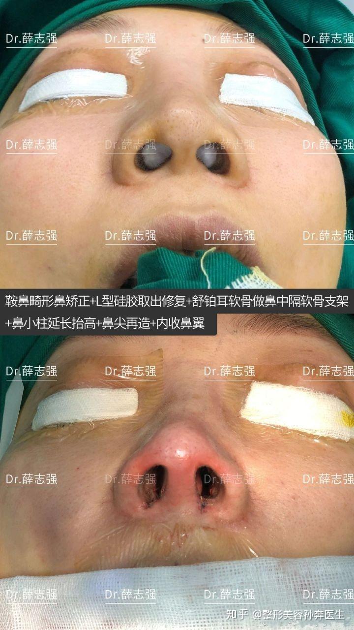 软骨发育不全的情况,也可以用【鼻翼外侧脚支撑移植物】的方法矫正