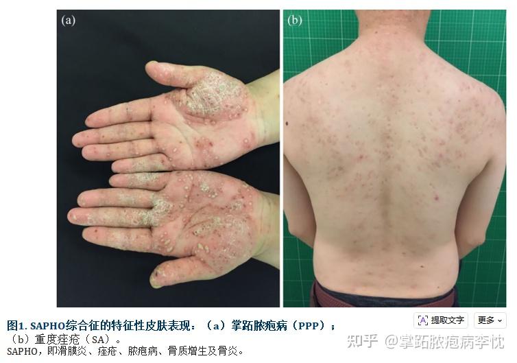 滑膜炎、痤疮、脓疱病、骨质增生和骨炎（SAPHO）综合征：回顾和更新！ - 知乎