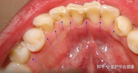 牙齒上有黑縫我有蛀牙了