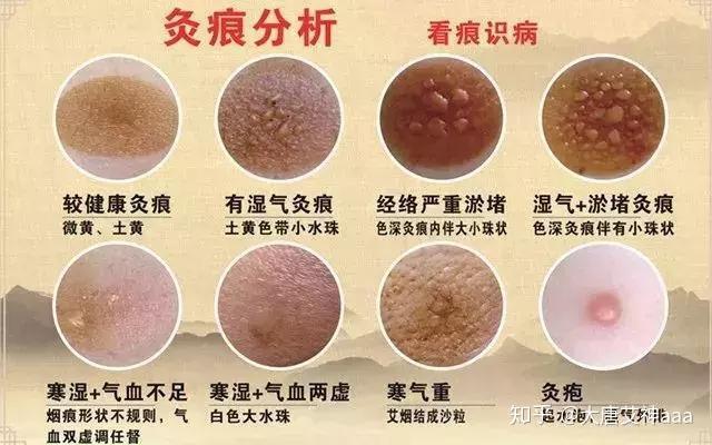 痒是阳气没有到达的缘故这样灸不会痒