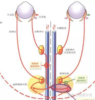 临床必须掌握的脑干综合征你都掌握了吗