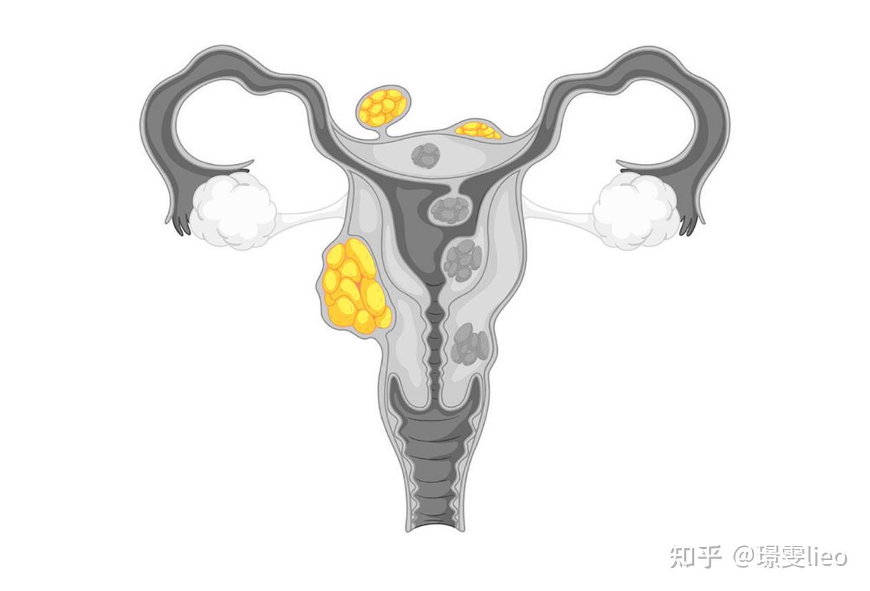 試管備孕遇見子宮肌瘤該如何處理