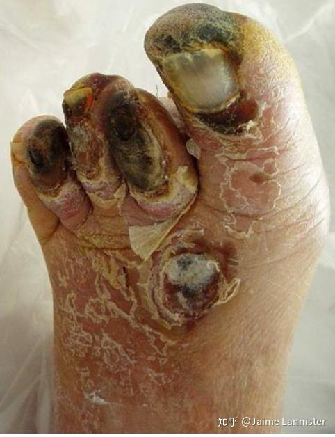 酮酸症中毒而Ⅱ型糖尿病为胰岛素的相对缺乏,就是说,胰岛b细胞分泌