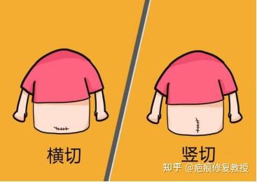 剖腹产疤痕又痒又难看?能去掉吗?医生告诉你如何修复 - 知乎