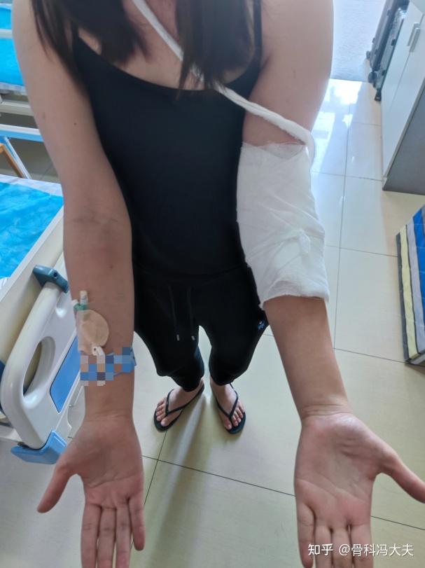 肘内翻畸形20余年手术矫形即刻恢复正常外观实现多年梦想