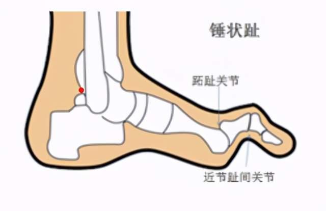 足趾畸形怎么办 知乎 足趾畸形怎么办 知乎
