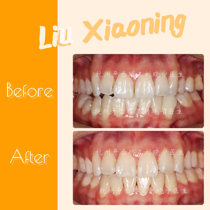 矫正牙齿医院排名_去医院矫正牙齿(2)