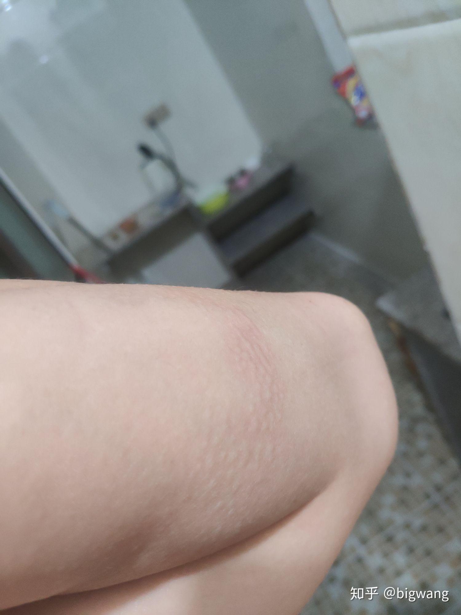 划痕荨麻疹 - 知乎