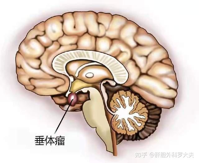 內分泌失調不孕一查居然是垂體瘤腦袋裡的這個腫瘤你需要了解