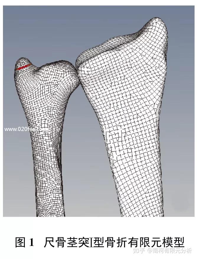 尺骨莖突骨折的建模和生物力學分析