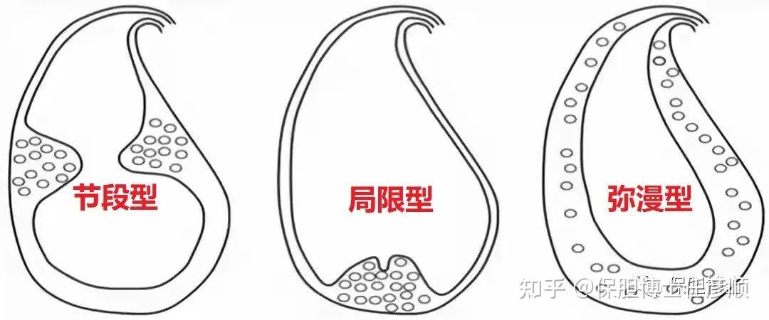 常伴有黏膜层陷入肌层形成罗-阿氏窦(rokitansky-aschoff