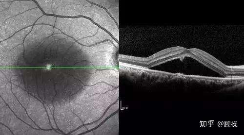 黄斑中心凹反光存在图片