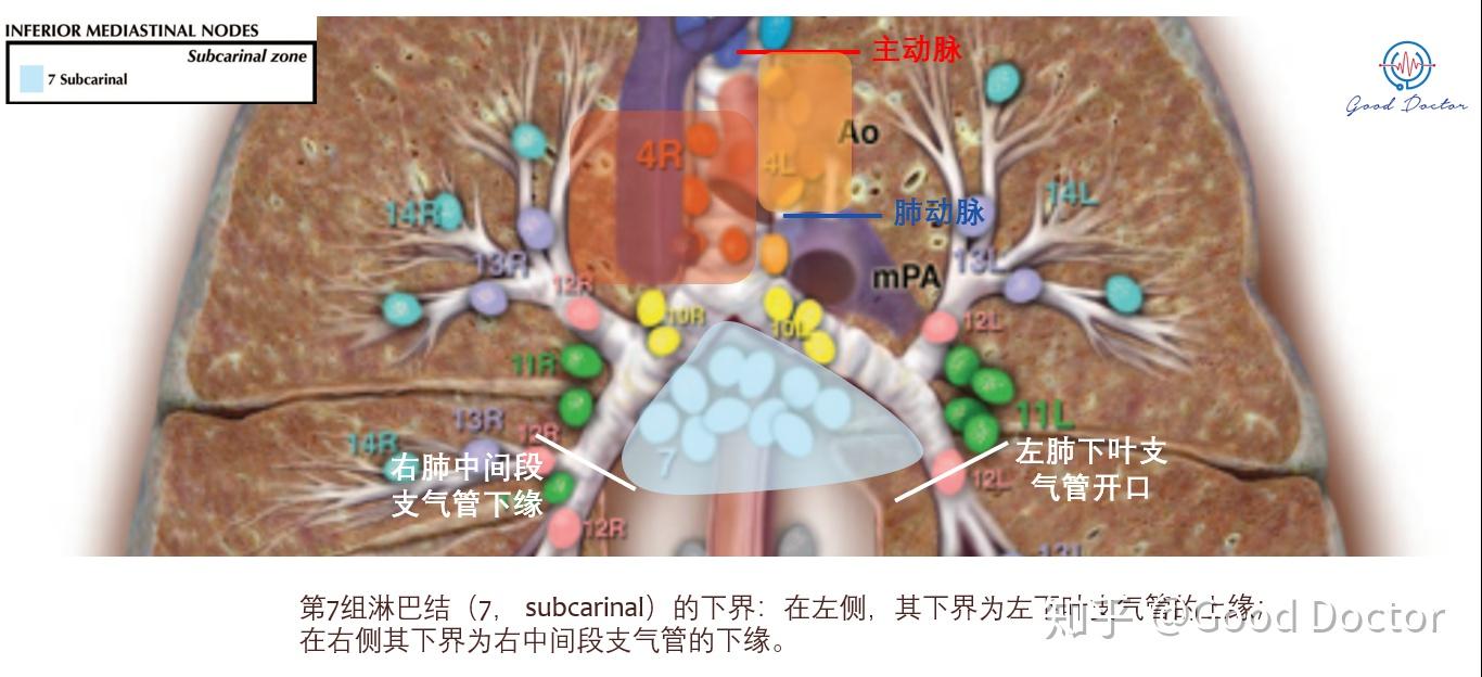 第8組淋巴結(#8 paraesophageal nodes (below carina) )位於食道壁