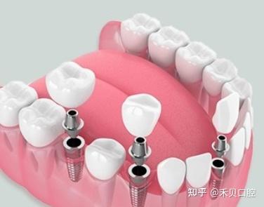 牙体、牙列缺损与牙列缺失的区别! - 知乎