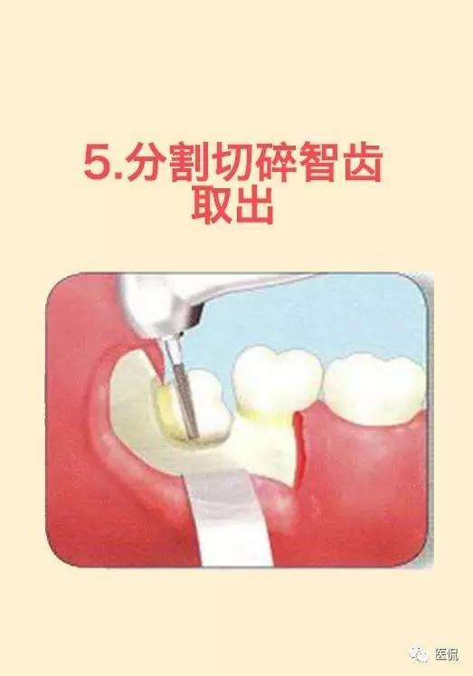 拔智齿的全步骤详解