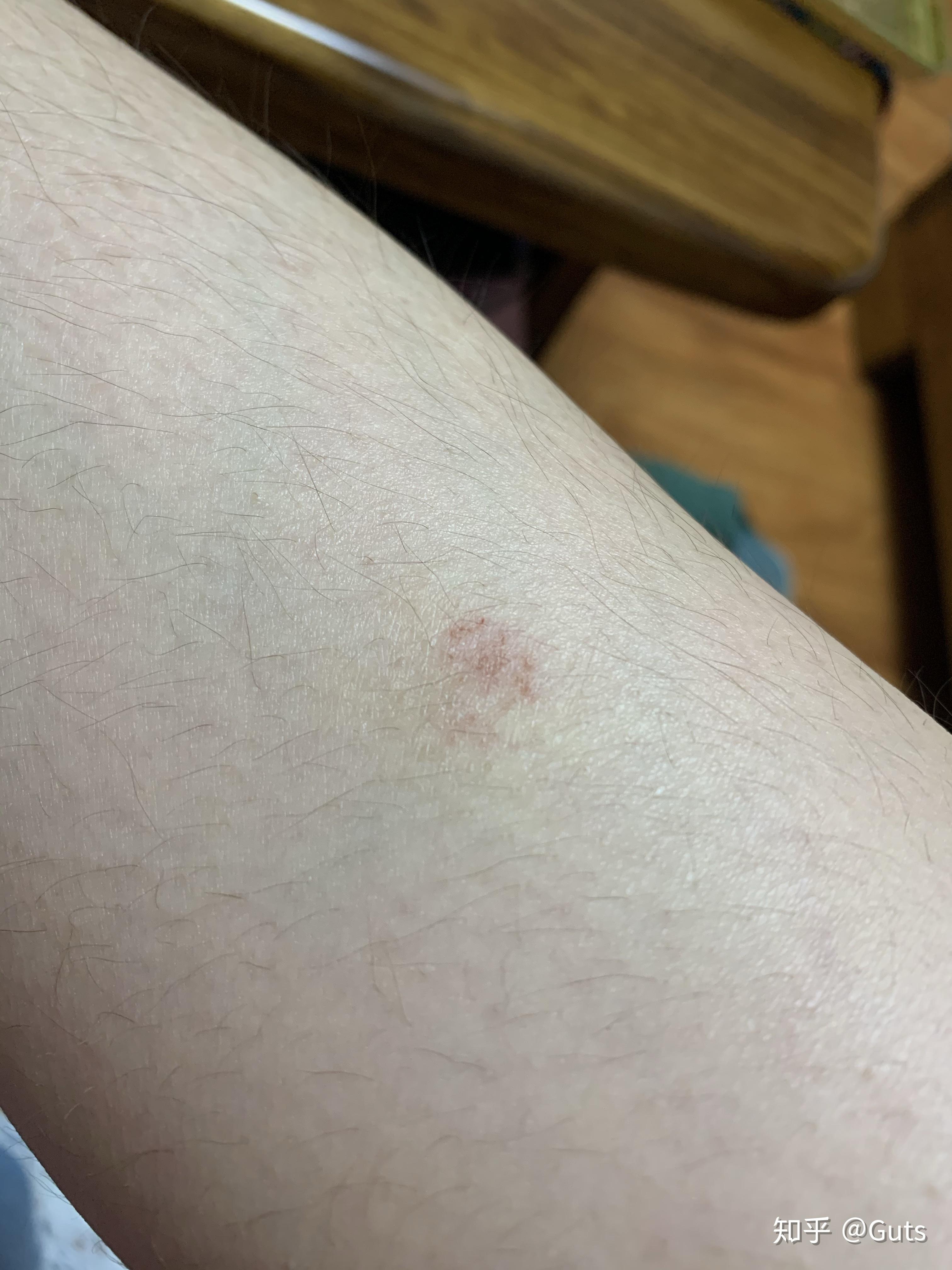 脚踝上皮肤莫名有一块变粗糙了如图乳液什么的也没用