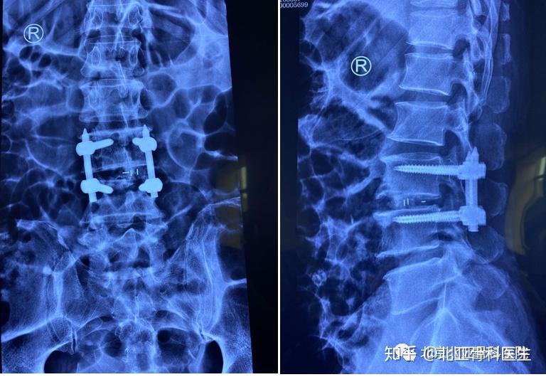 "量体裁衣"——微创技术解决重度腰椎间盘突出!