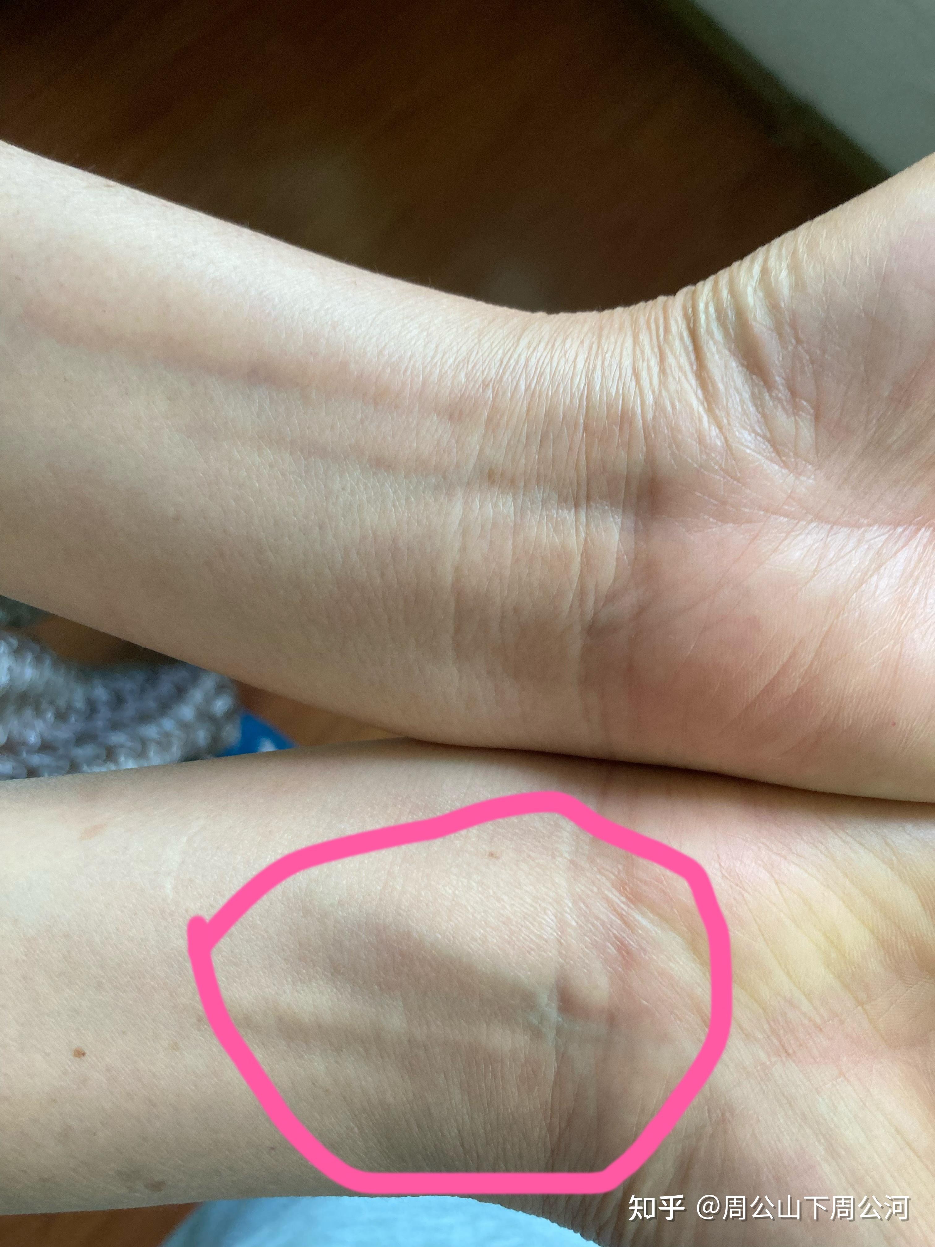 血管鼓起来了,怎么回事啊?