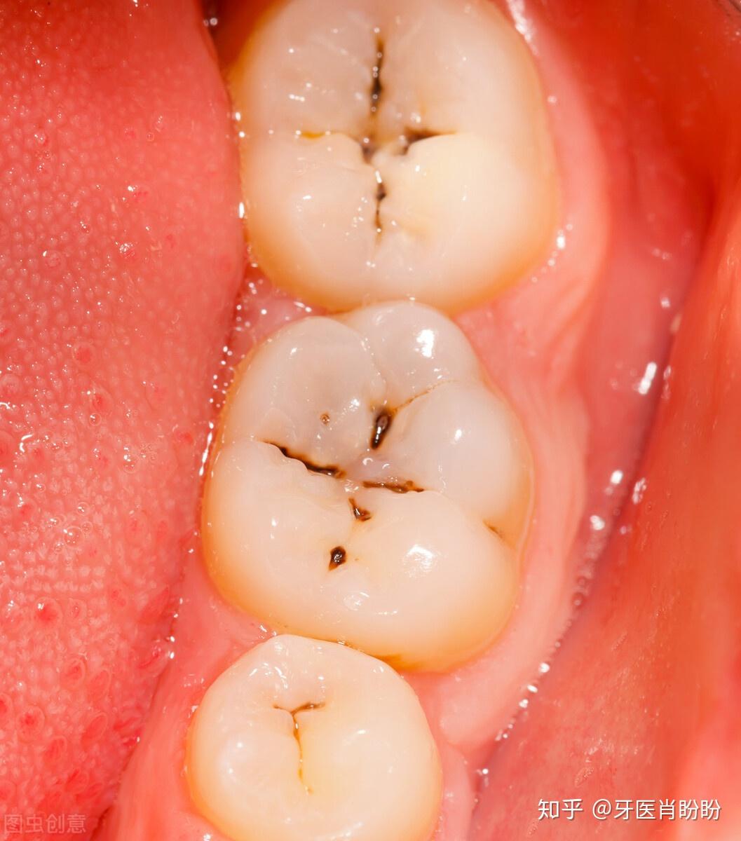 龋坏的牙洞内长息肉——治疗牙髓息肉一例 - 知乎