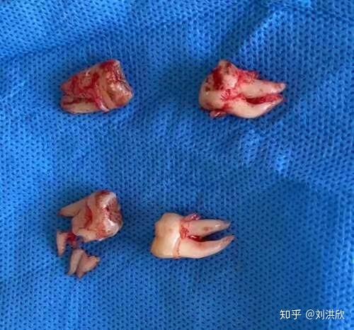 跳舞的牙根9.5晚上也没有疼醒,不,是不疼!就是张不开嘴,继续头孢!