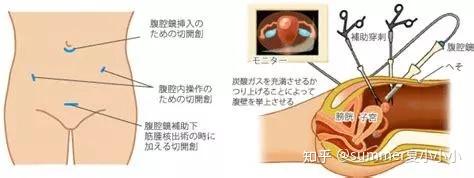 科普 子宫肌瘤的检查和诊治方式 知乎