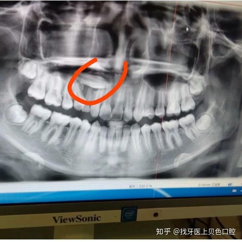 上颌尖牙埋伏图片