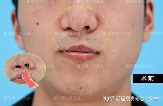 【科普】唇裂继发唇鼻畸形可以完全修复好吗?唇裂鼻修复医生有话说! - 知乎