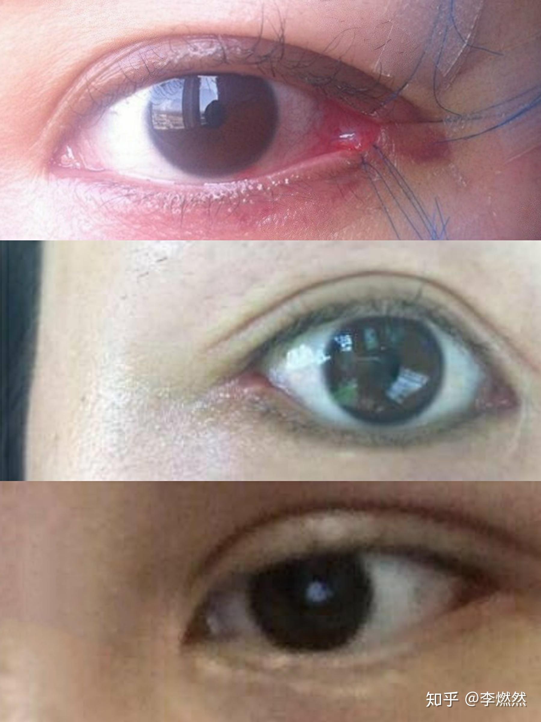 Red spot on eye: Causes and treatment