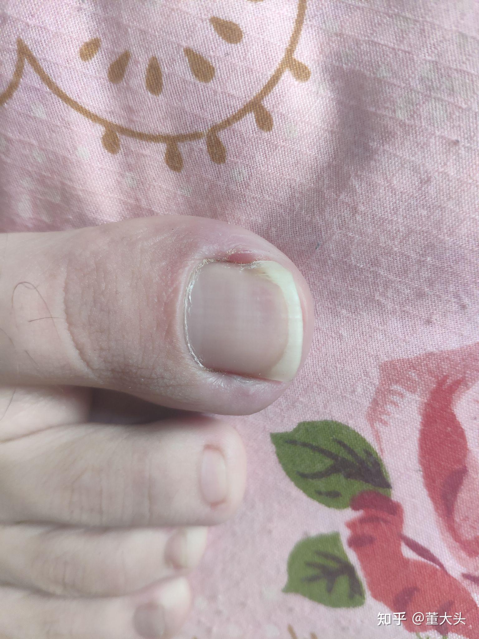 自述:用棉棒和双氧水治疗甲沟炎的过程