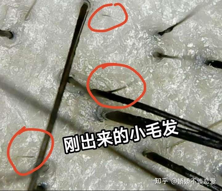皮肤科医生亲测,两个月实现发量快速增长!