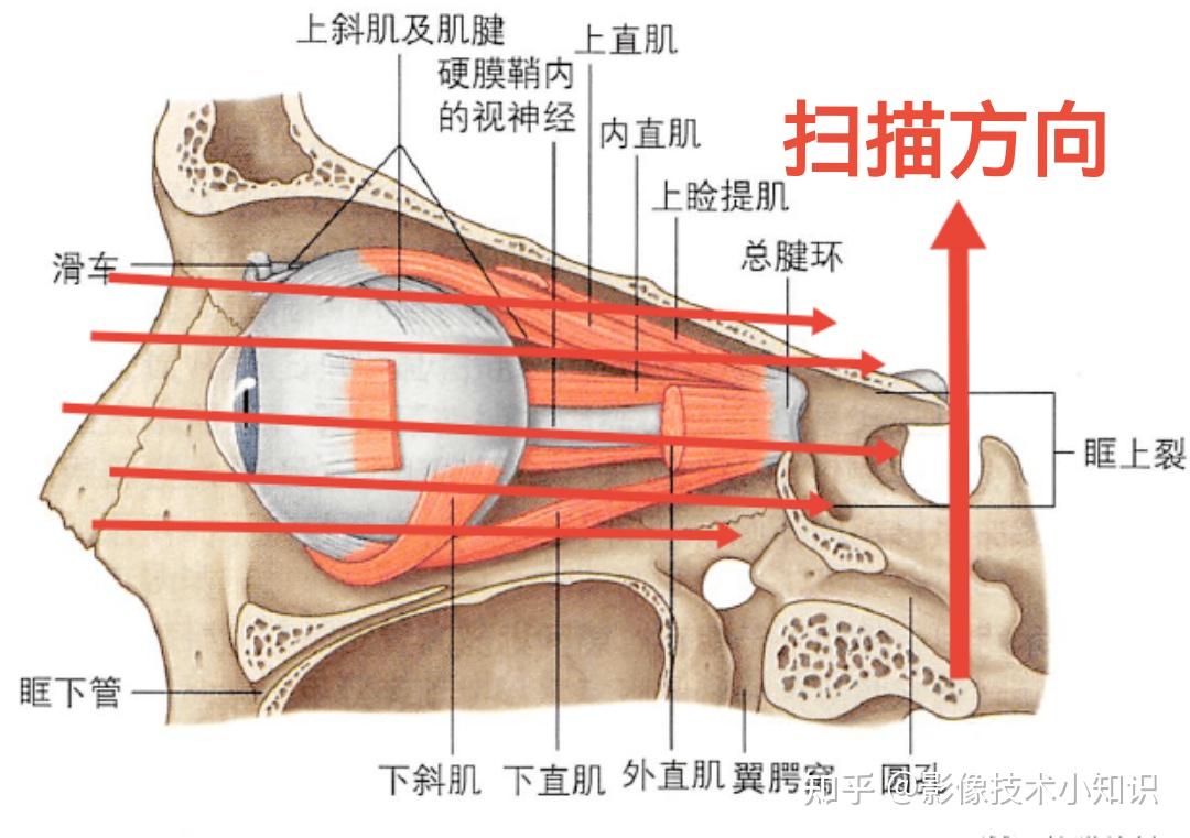 眼肌ct解剖图片