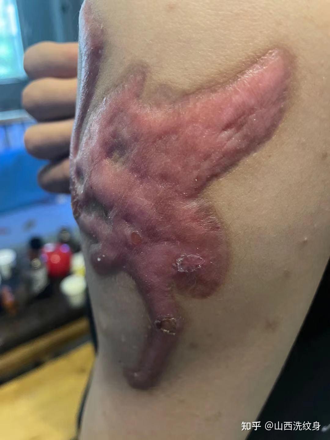 第三是洗后恢复期间抓挠刺激,胡乱用药,或疤痕体质引起的.