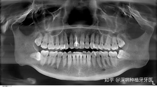 根尖囊腫生長很慢,初期外在表現為牙齒顏色變化,由於患牙牙骺已壞死