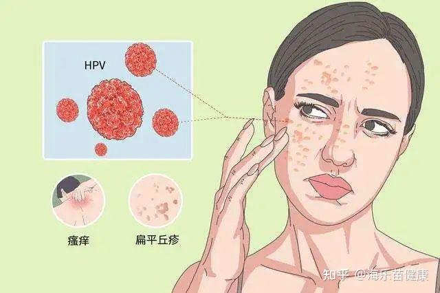 无论男女,身上长这5种肉疙瘩,可能是感染了hpv!