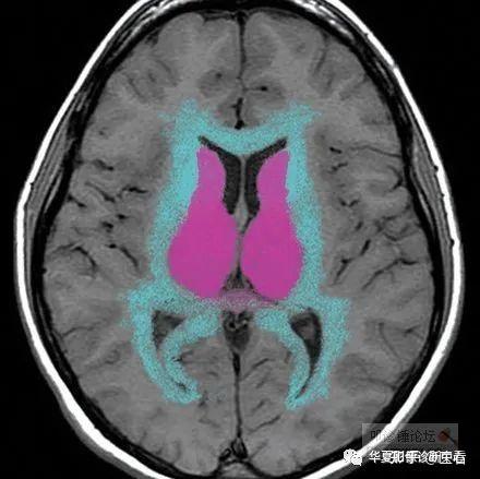 絕對乾貨6張圖完美解釋大腦靜脈系統mrv及各自引流區域