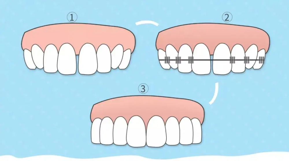 二,牙齿矫正的流程是怎样的?