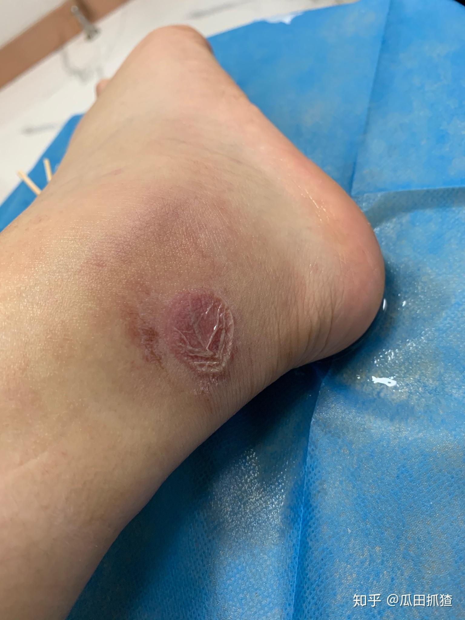 被隐翅虫咬了会怎么样? - 知乎