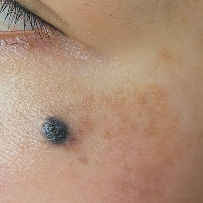 胎记色素痣手术治疗是该选择一次切除还是分次切除