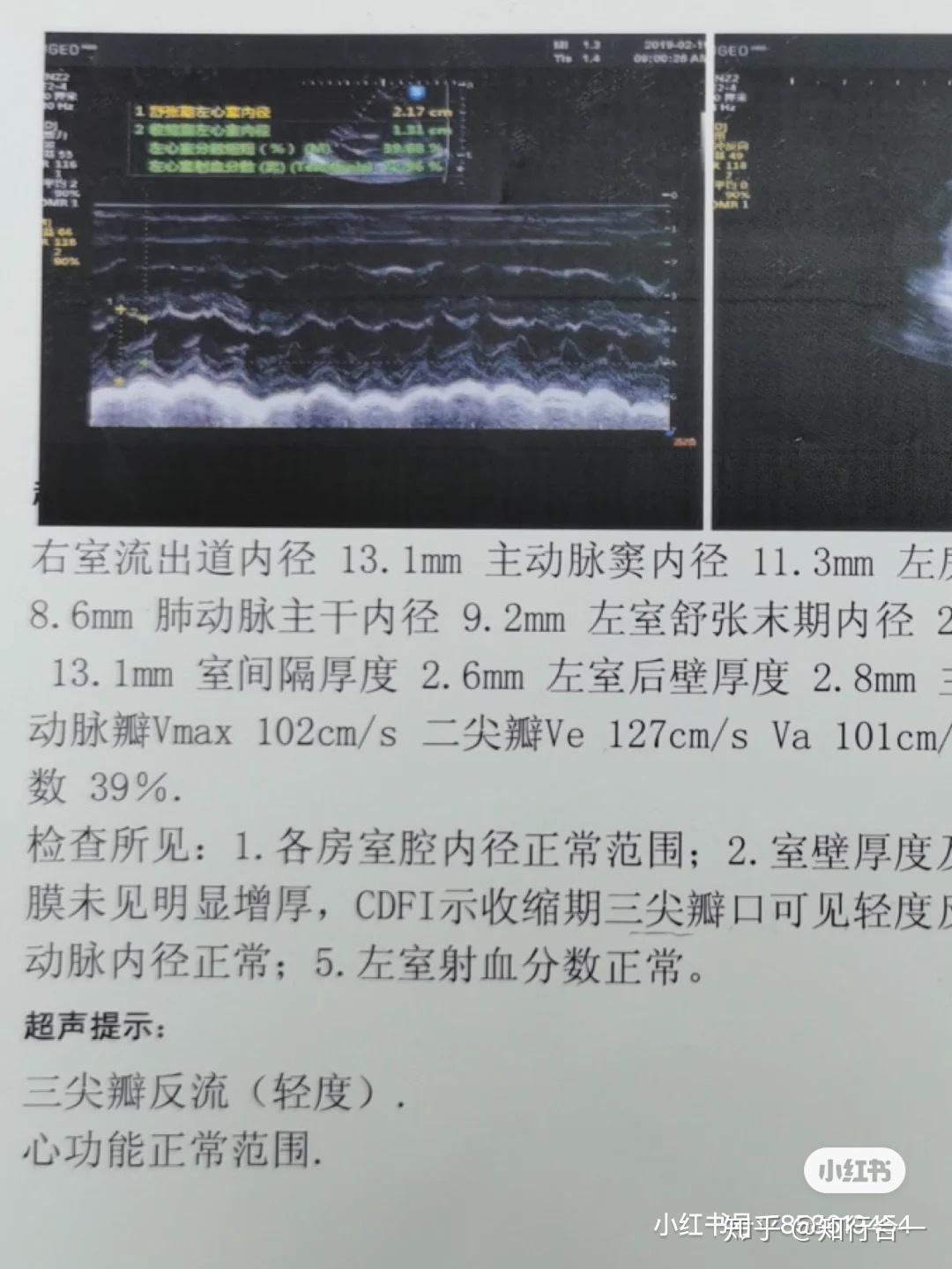 出生三天心动彩超(3)无分流型:如肺动脉狭窄,主动脉狭窄和主动脉缩窄