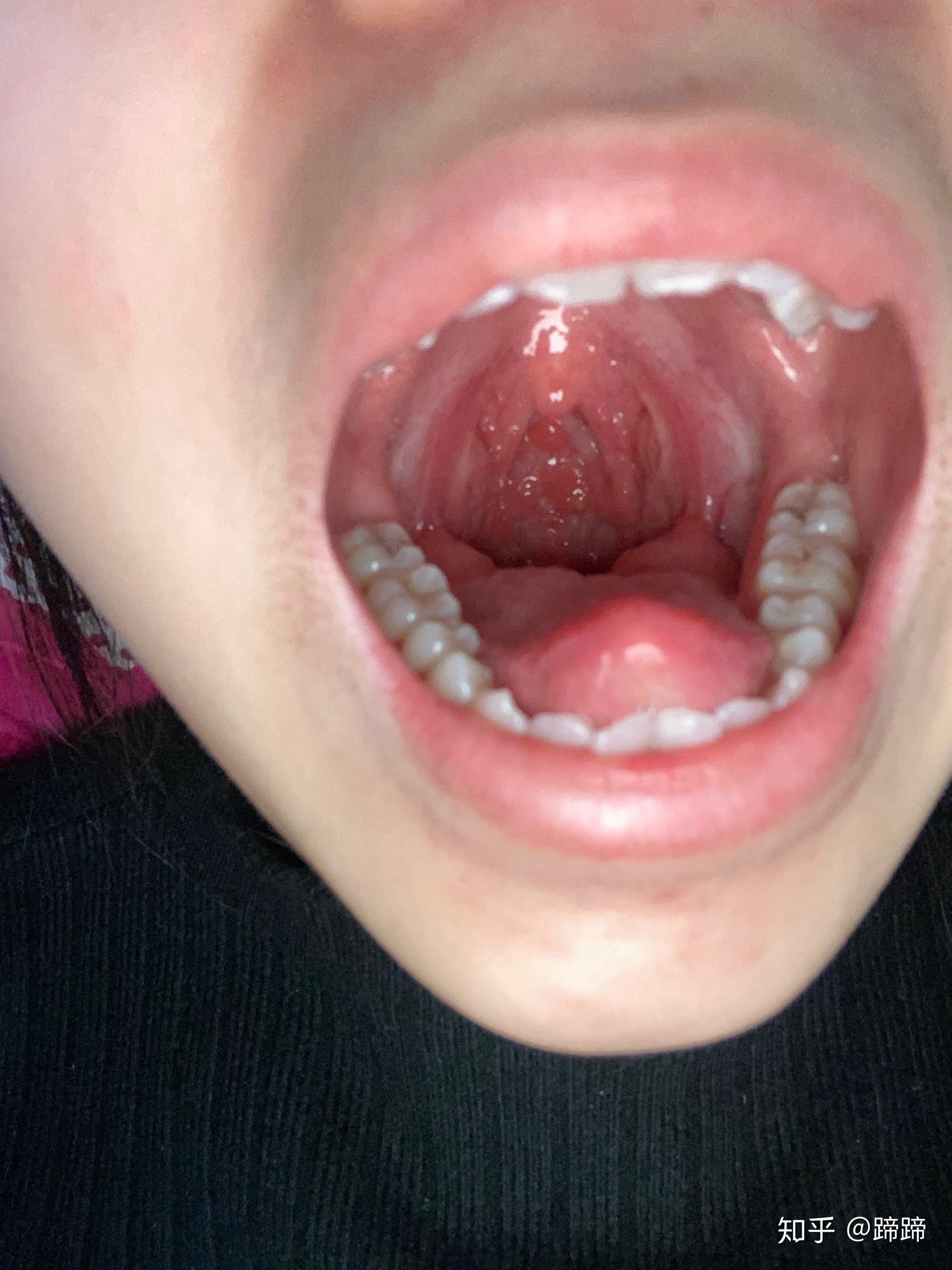 儿童喉咙正常图片